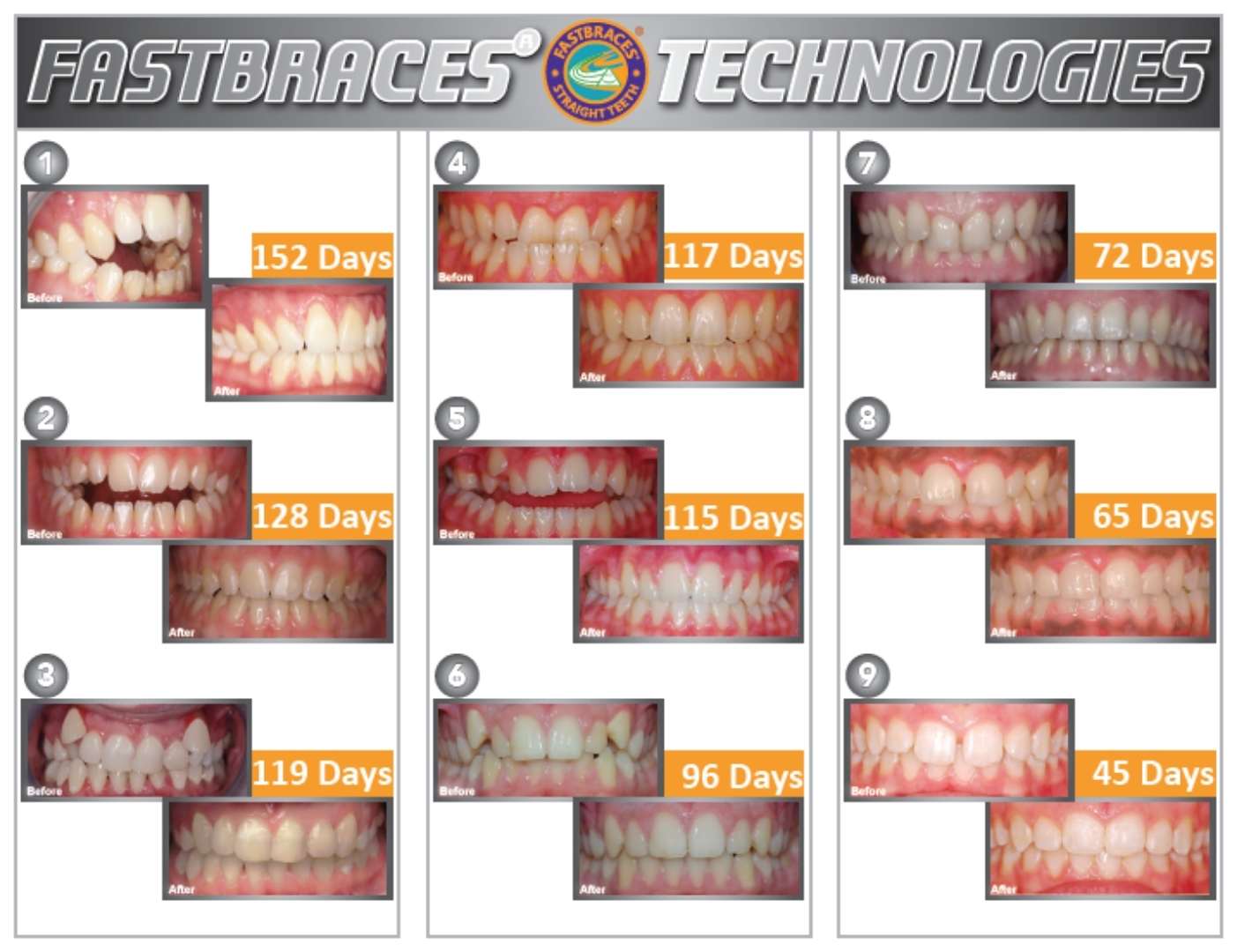 FASTBRACES Technologies Images FASTBRACES Technologies Images